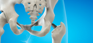 Zimmer Biomet Hip System Recall due to increased risk of fracture