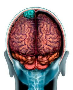 Meningioma potentially caused by depo-provera. Know your rights.